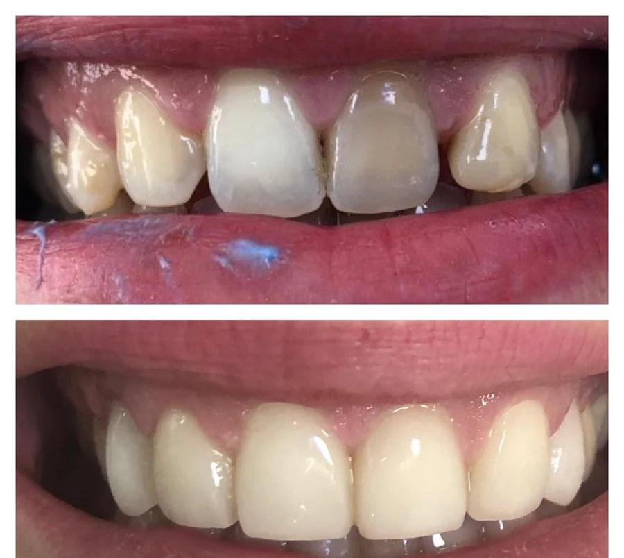 Bloc incisif maxillaire dont une incisive latérale est nettement plus sombre que les dents voisines, puis après pose de facettes céramique — photographie composite réunissant la situation avant, en haut, et la situation après, en bas.