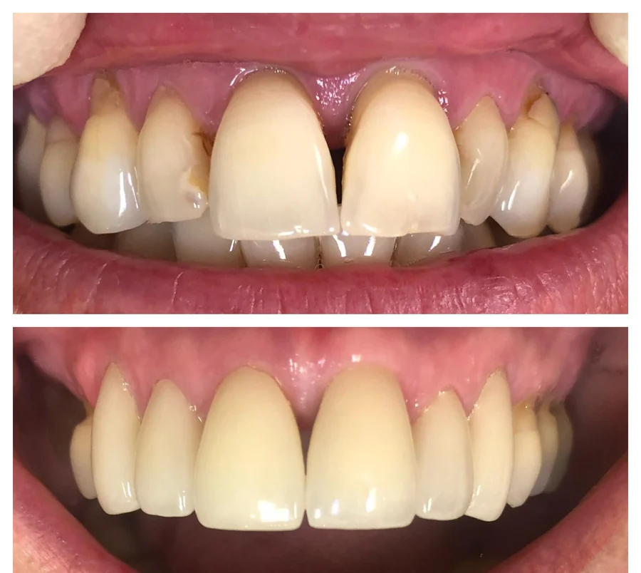 Incisives maxillaires de forme irrégulière avec un espace visible sous le point de contact, puis après pose de facettes céramique — photographie composite réunissant la situation avant, en haut, et la situation après, en bas.