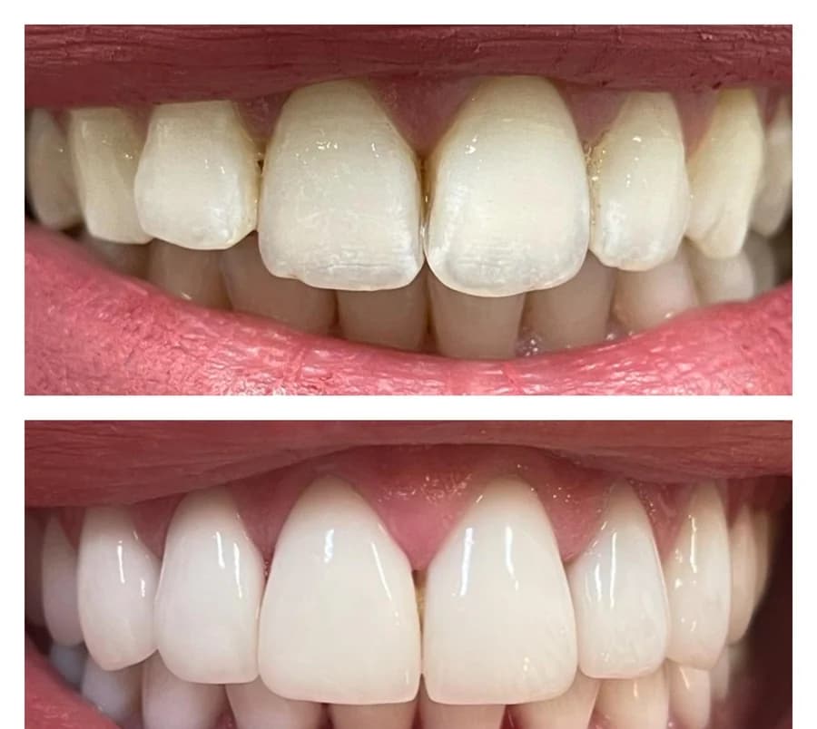 Sourire de face dont les incisives maxillaires présentent une teinte inégale, puis après pose de facettes céramique — photographie composite réunissant la situation avant, en haut, et la situation après, en bas.
