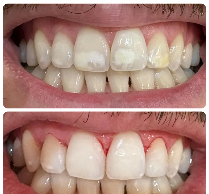 Taches blanches sur les incisives maxillaires, sourire de face, dents en contact. Moitié haute, avant traitement : des plages blanches opaques se détachent sur l’émail des incisives centrales et latérales. Moitié basse, après traitement : l’émail est d’aspect plus homogène, les plages se distinguent nettement moins de la dent.